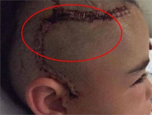 医院来了个十岁男孩,只因头上有一条蜈蚣疤,妈妈心疼得哭泣!