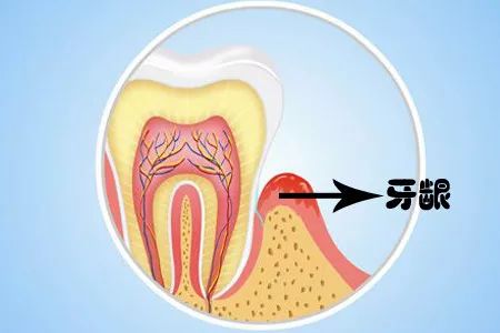 牙龈萎缩是什么原因造成的?