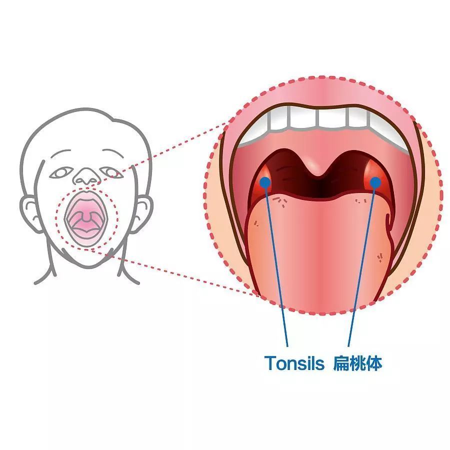 孩子扁桃體肥大,發炎,一定要手術切除嗎?