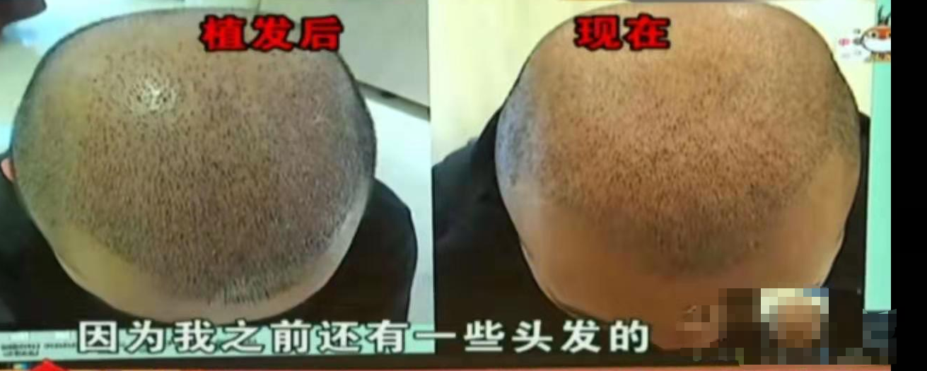 光头植发失败(植发后光头怎么上班)