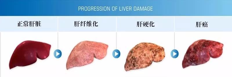 前沿:干细胞治疗乙型肝炎肝硬化临床最新研究