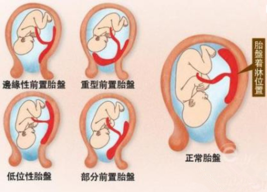 怀孕24周胎儿停育