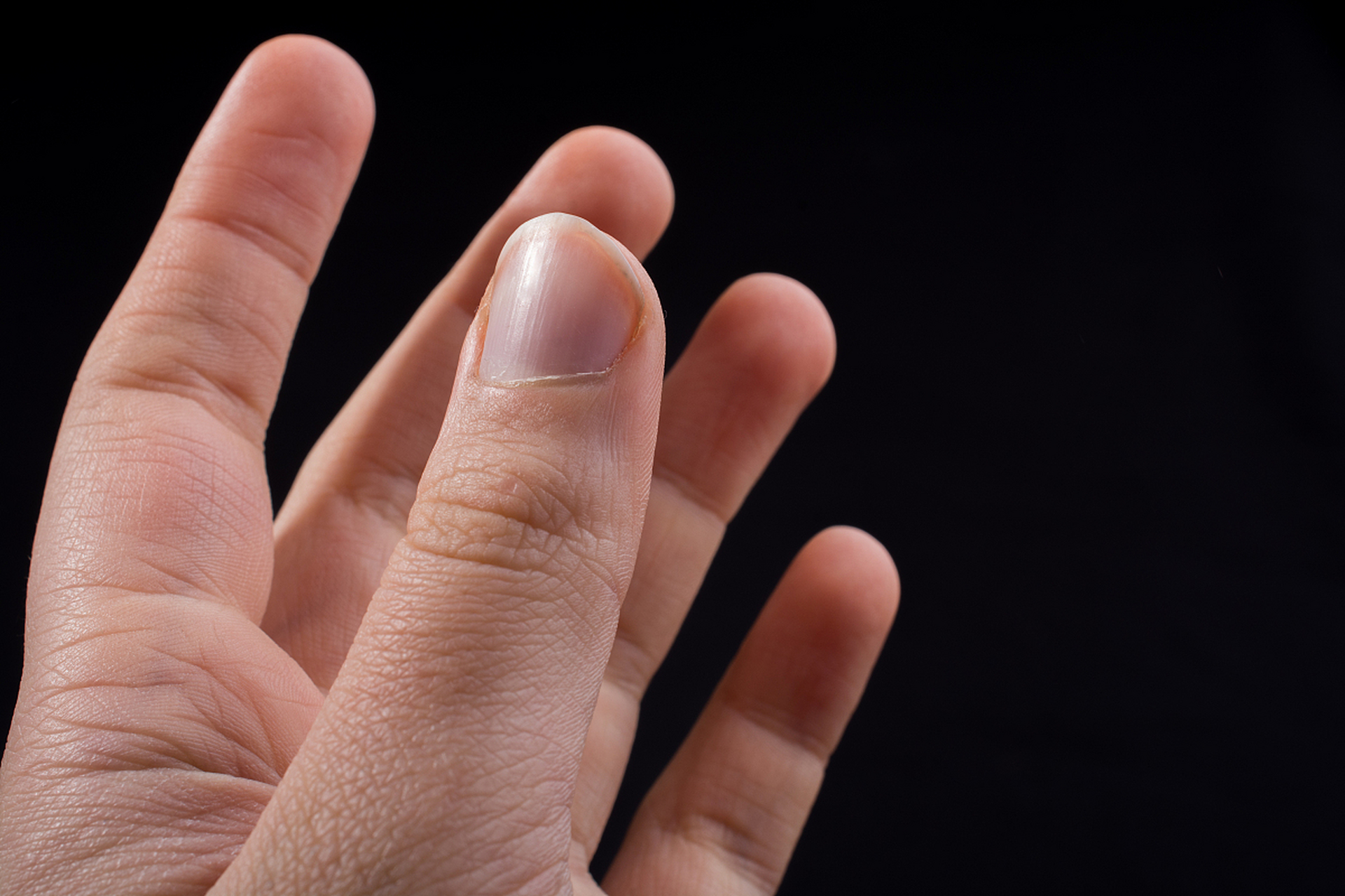 杵状指早期症状是什么	杵状指早期症状是手指或足趾末端增生,肥厚,呈