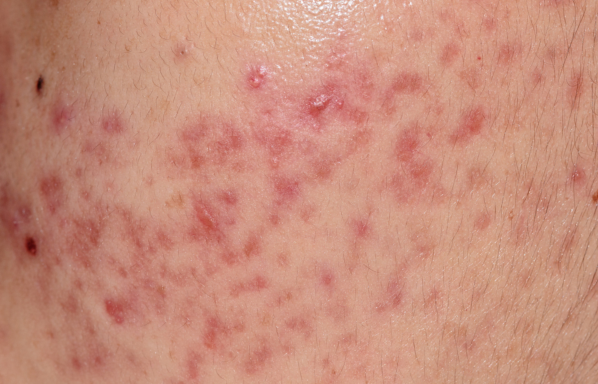 毛囊炎怎么治才能根除脸上的痘痘 #红蓝光祛痘#   毛囊炎是许多人面临