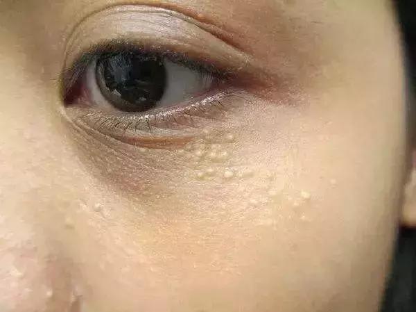 眼霜真的会导致脂肪粒吗?|科普