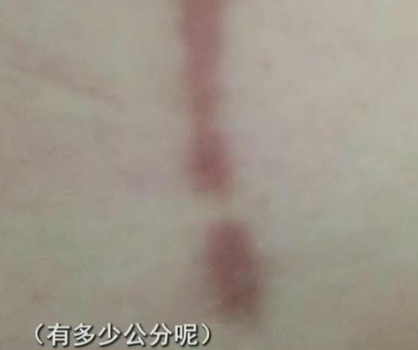 女子因胸大影响自己的正常生活,三年前做缩胸手术,如今后悔不已