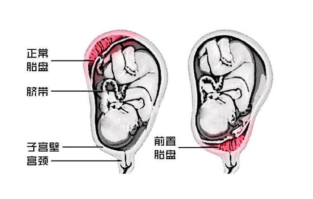 孕妇胎盘前壁好还是后壁好?只要在这个位置都正常