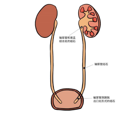 输尿管在哪个位置图片