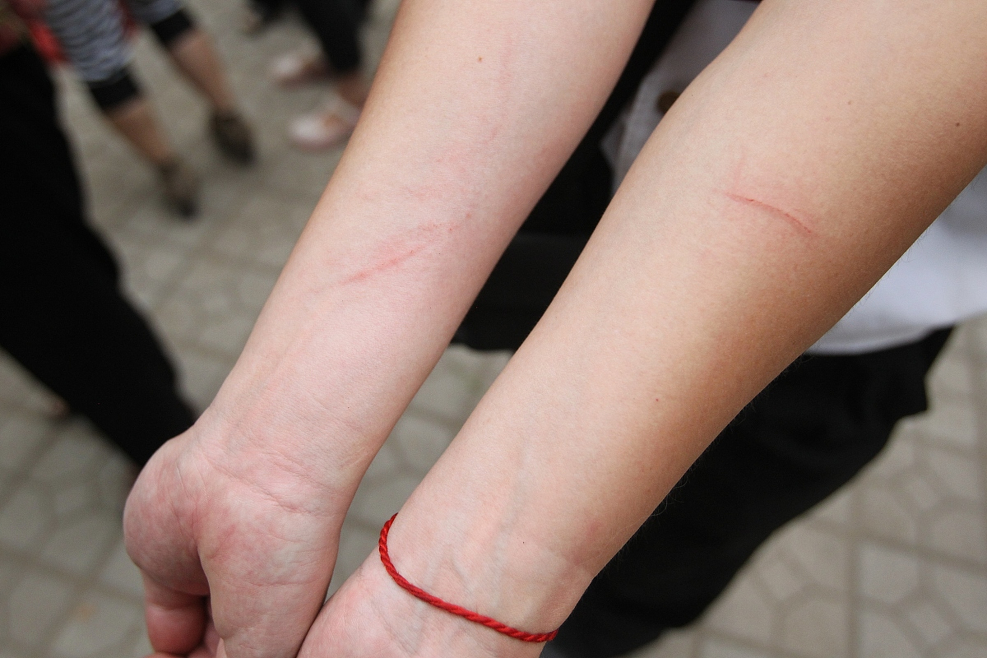 宝宝指甲抓伤自己怎么办?