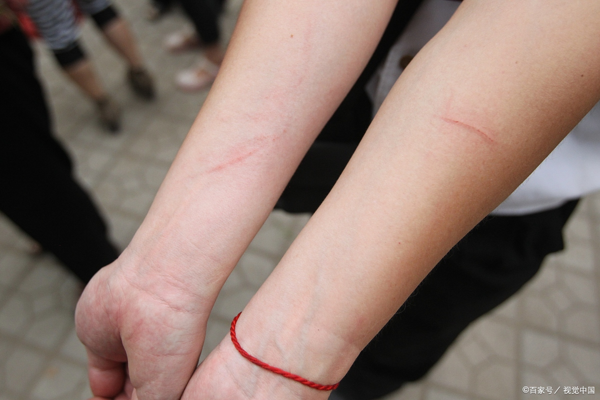 一个青春期少女伤痕累累的胳膊