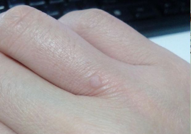 3种长在皮肤上的肉疙瘩,平常可能感觉不大,但日常要引起重视