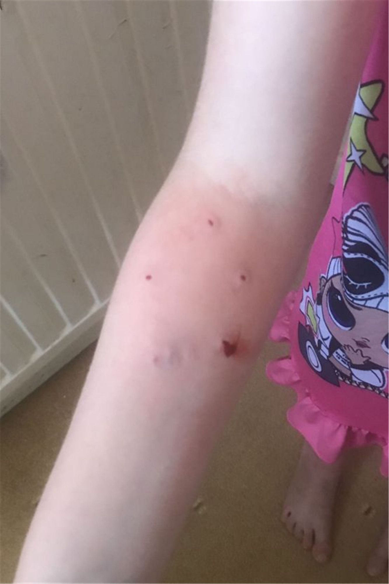 6岁小女孩被宠物猫咬伤住院,感染病菌差点死亡