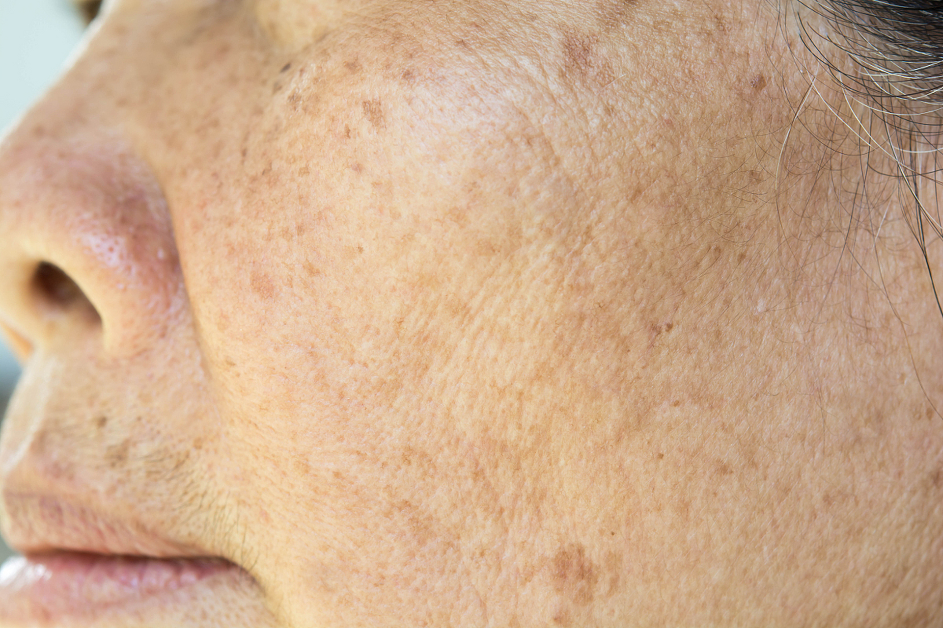 老年斑怎样才能彻底的去掉  彻底去除老年斑的方法有