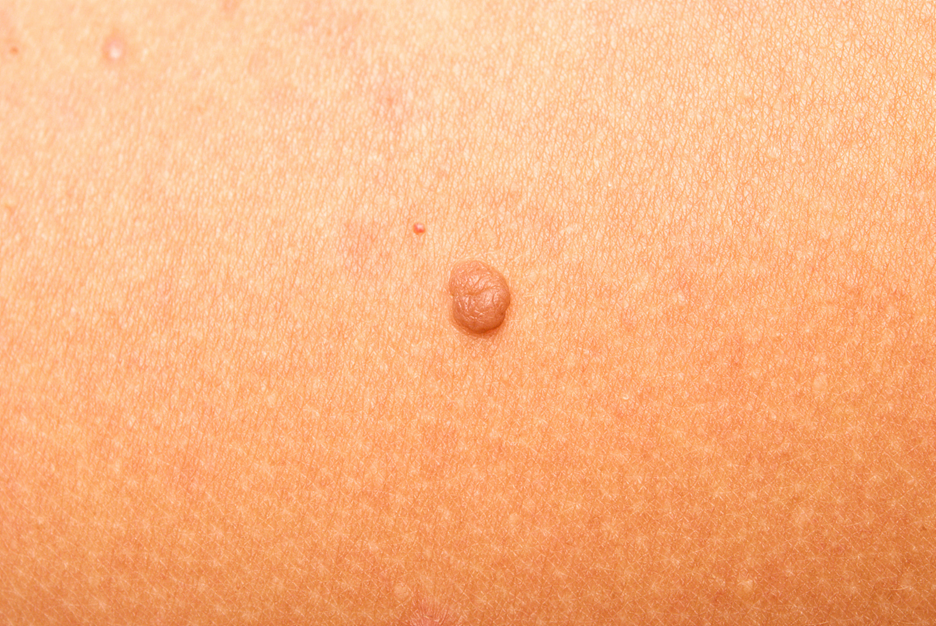 恒星计划# 龟头冠状沟有小肉刺可能是珍珠状阴茎丘疹.