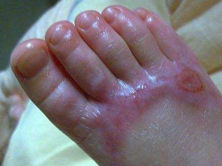 7岁的儿子被开水烫伤,医生检查完伤口后,连连称赞宝妈做得好!