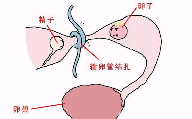 女性结扎图图片