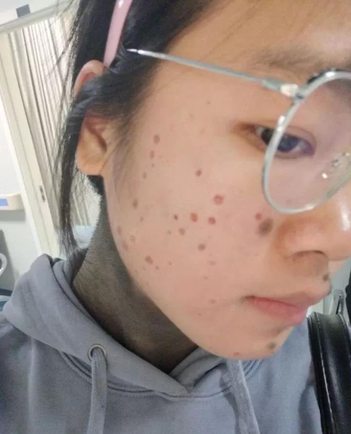 女孩长的丑可怜么?这个满脸痣的女孩让知乎上万人为她点赞