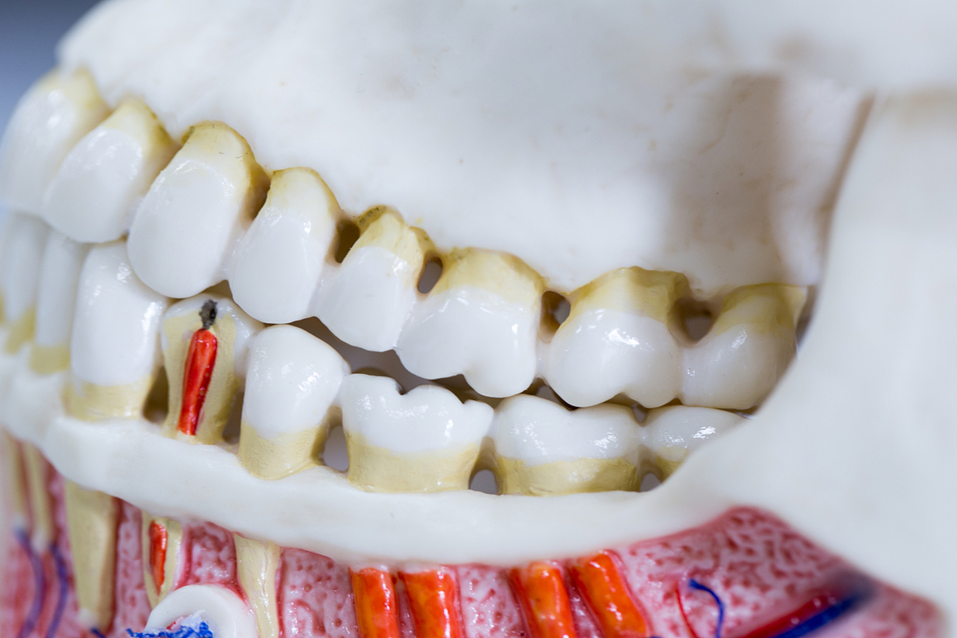 阻生智齿一定要拔吗	阻生智齿通常不一定要拔.