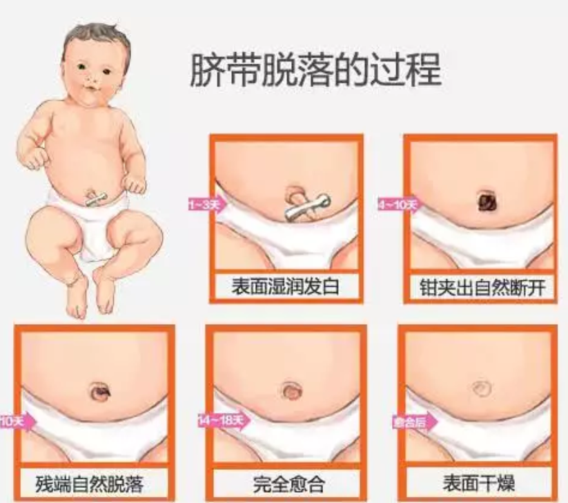 婴儿脐带多久脱落正常图片