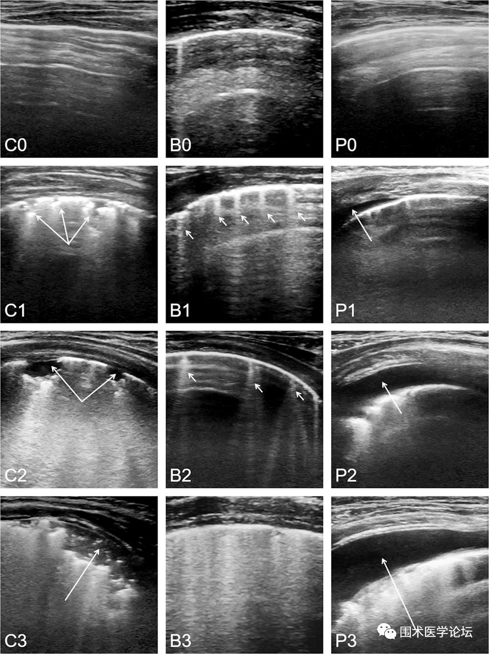 anesthesiology:围术期肺部超声在小儿心脏手术中的应用