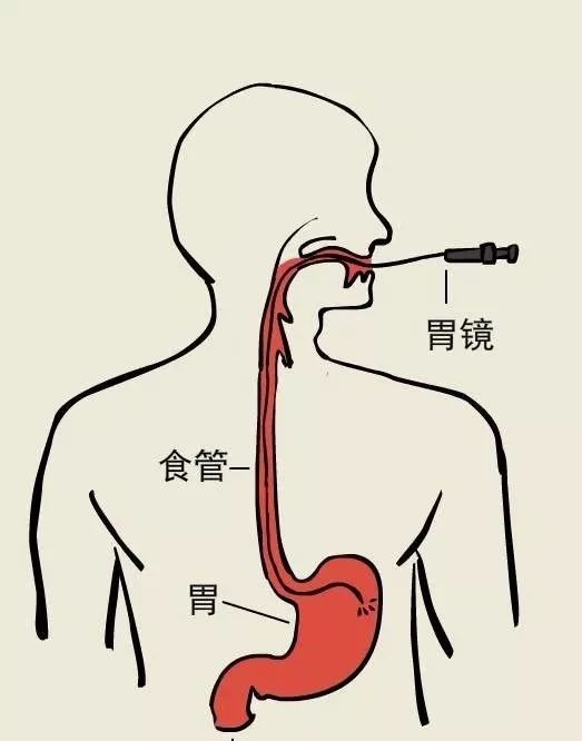 无痛胃镜与普通胃镜,哪个效果更好?