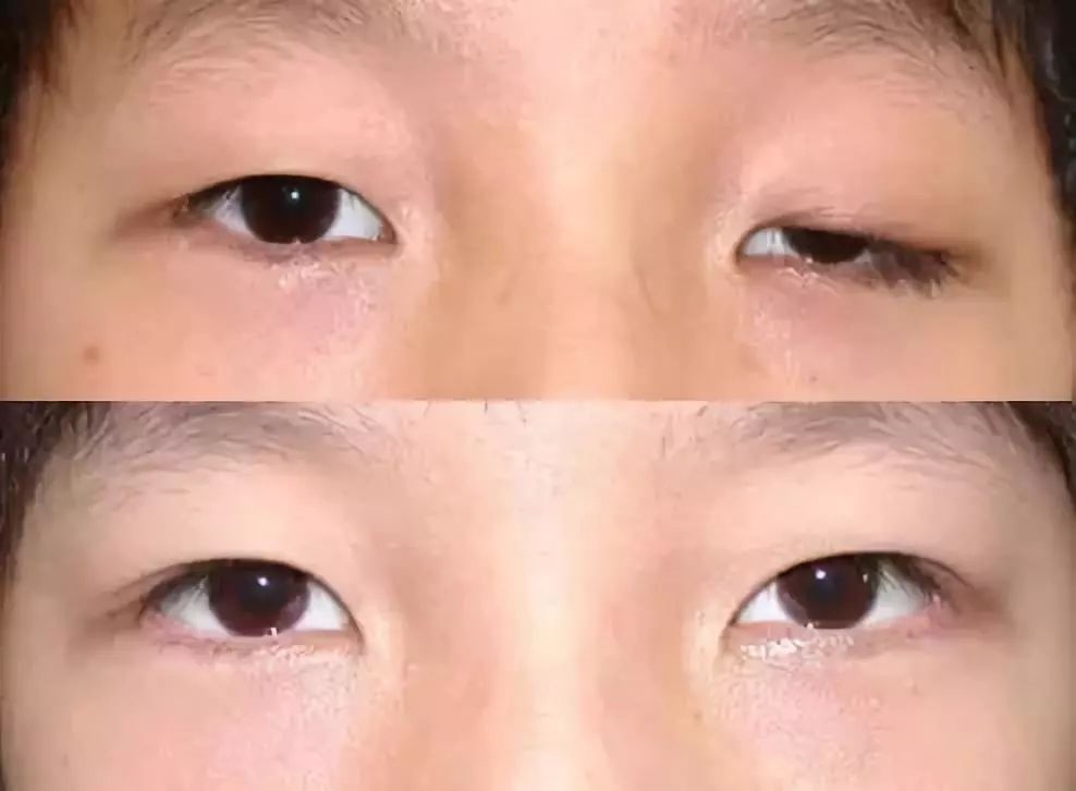 上睑下垂