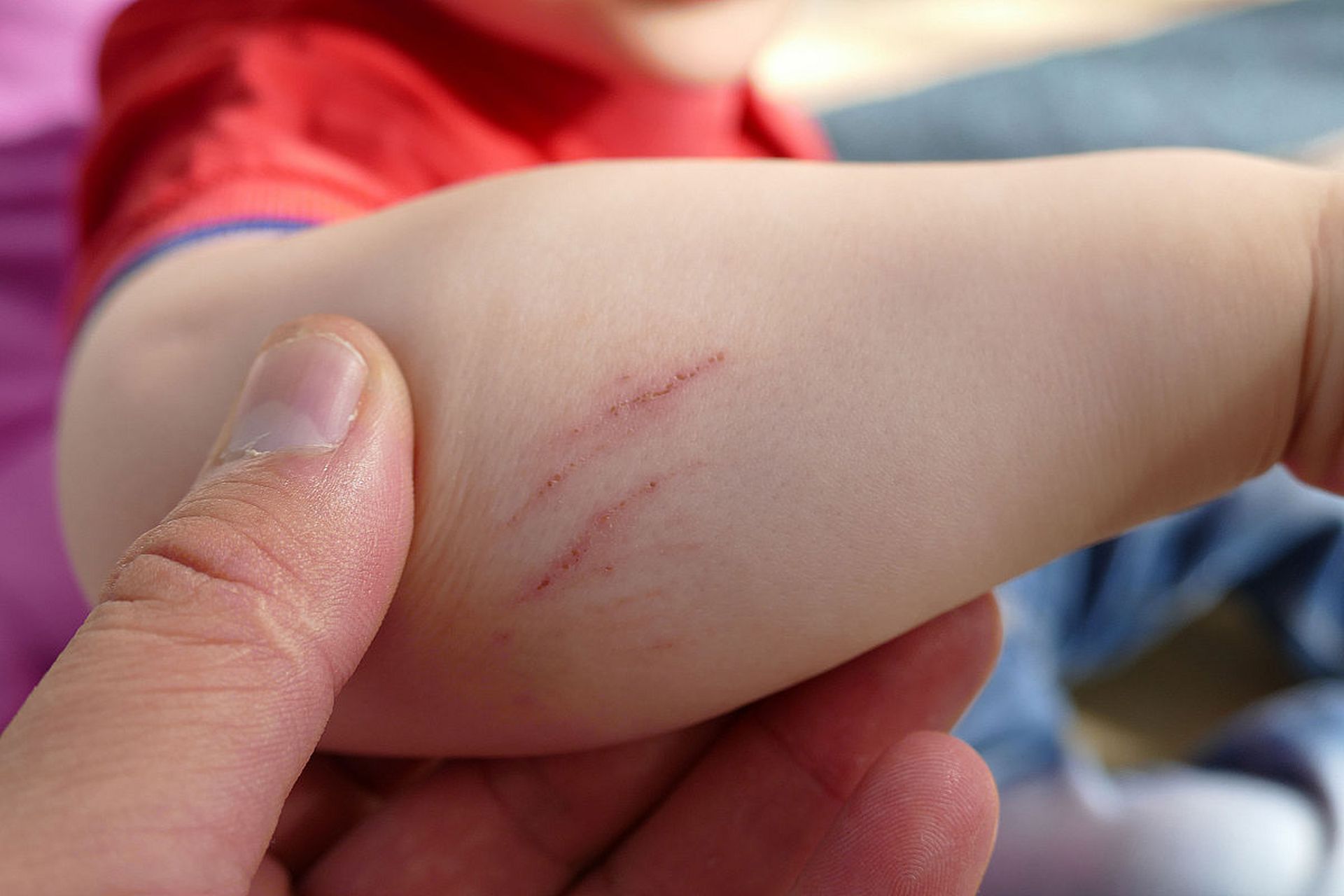 默认分类# 6月14日,陕西西安#,一9岁女孩因猫抓病发烧,到西安市儿童