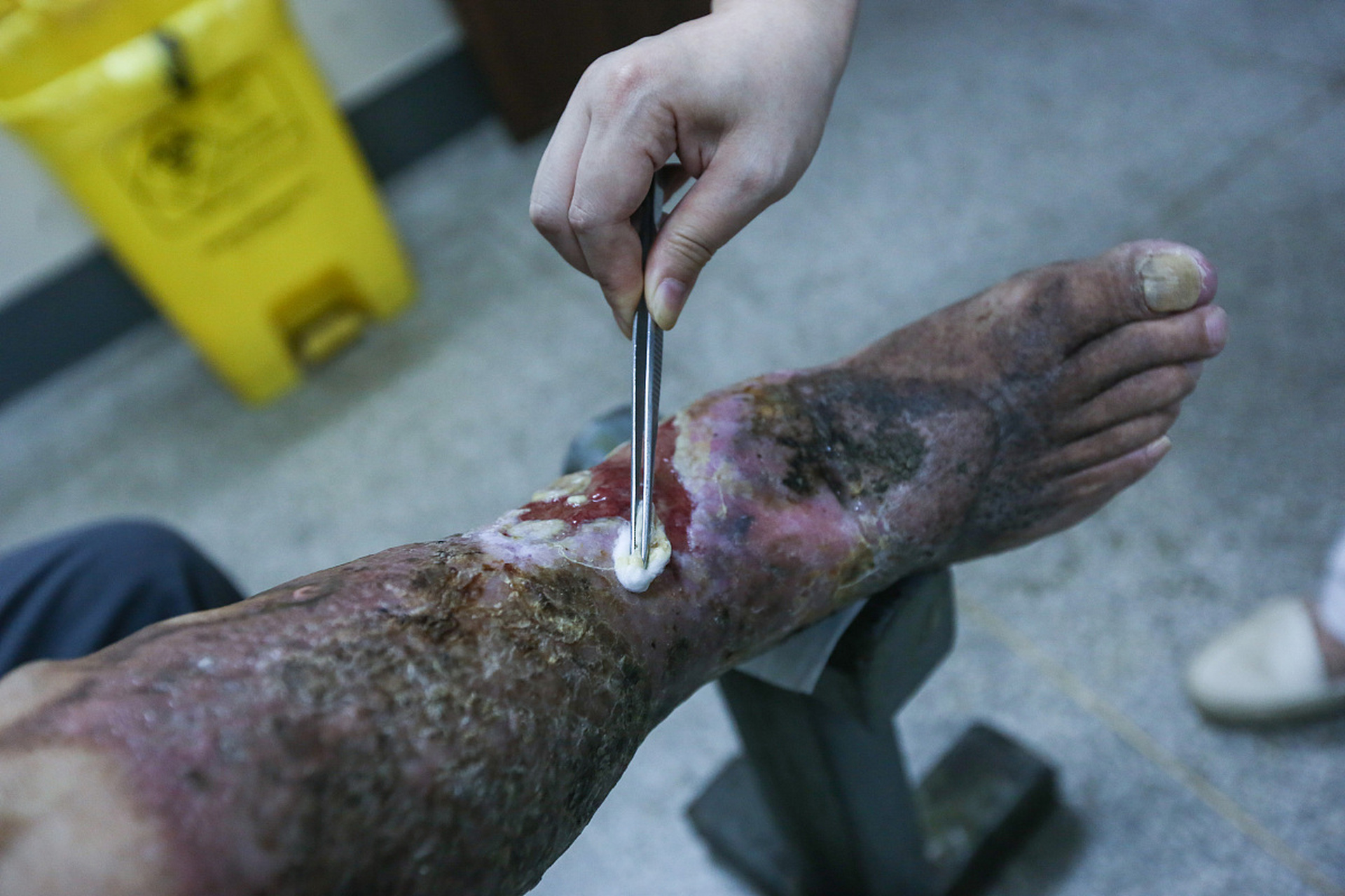 只因踩了根铁钉竟然窒息身亡,破伤风究竟有多可怕?