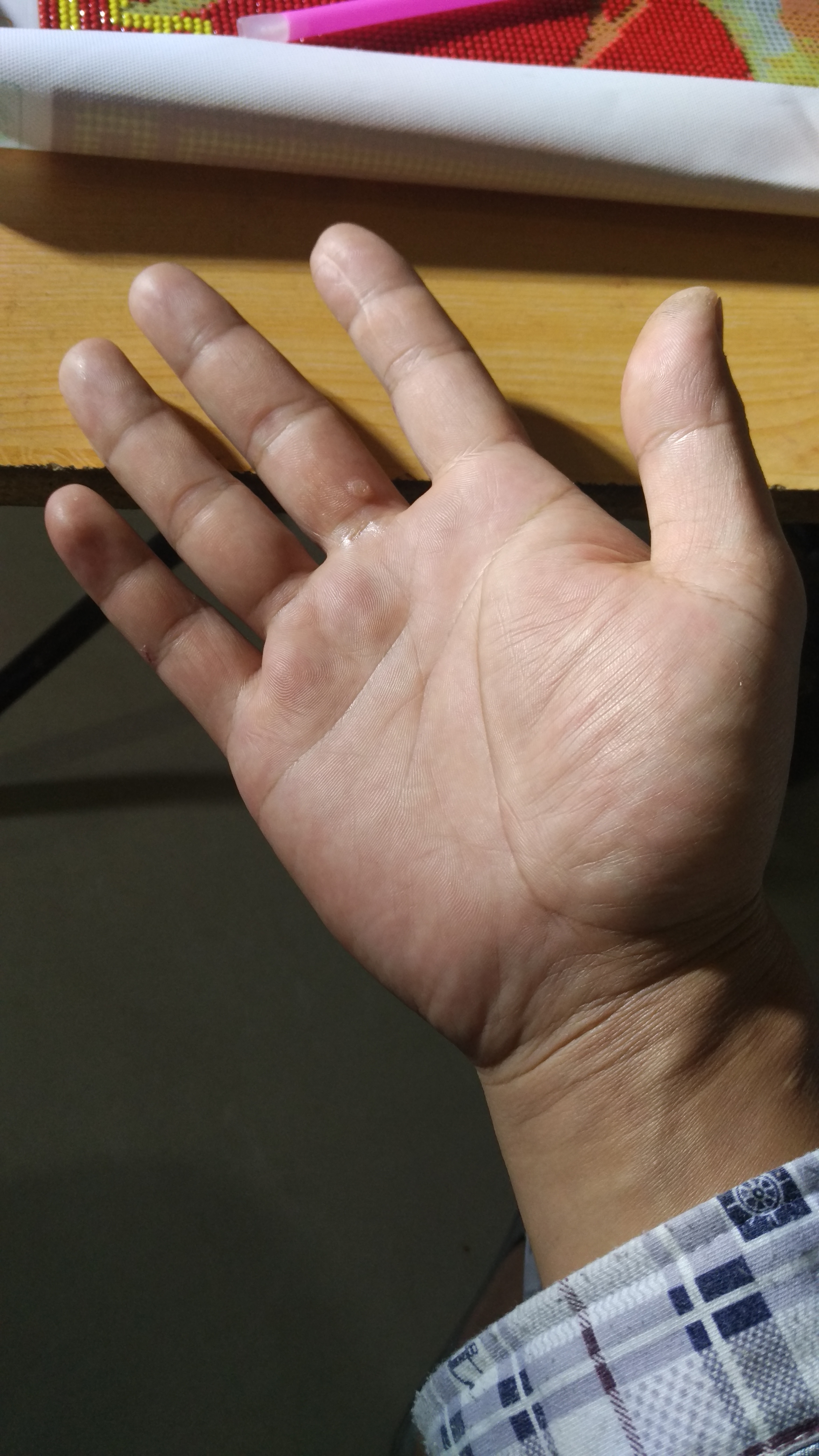 最近手上长了个瘊子,大家有什么好的方法可以去除吗?