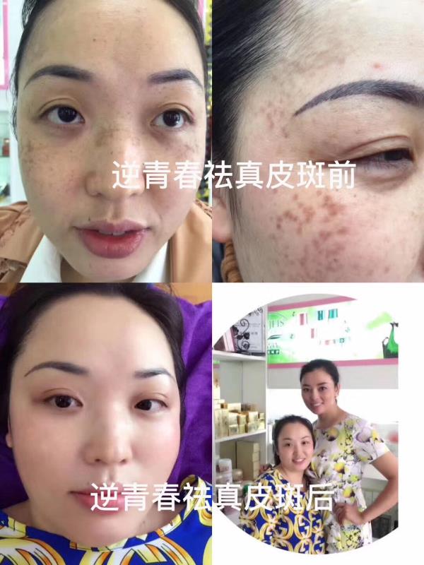 逆青春祛斑怎么样