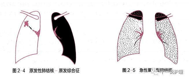 传染病 肺结核分型