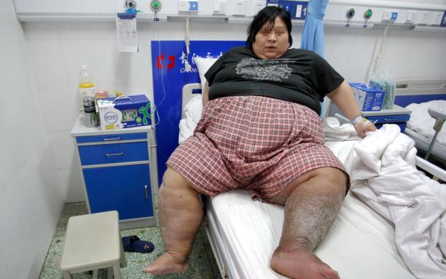 身高1米6,体重400斤,日常走路靠挪,睡觉靠坐,弯腰是奢望