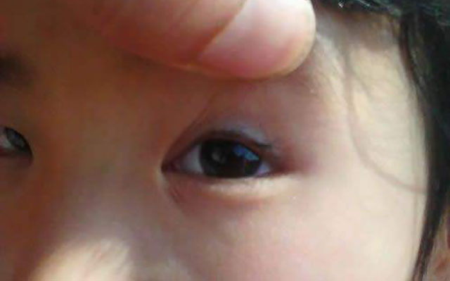 宝宝总是揉眼睛?可能是睫毛倒长了,这四点宝妈要注意!