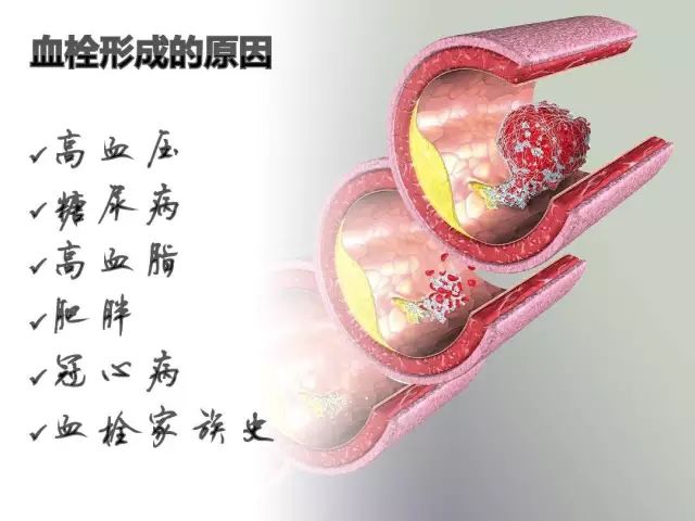 从血管中竟然取出10厘米血栓,过了40岁都要这样防血栓