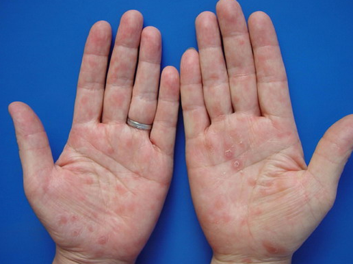 "梅毒"上身时,身体可能会露出这3个"马脚",最好别忽视