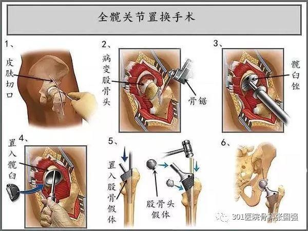 成人先天性髋关节脱位 怎么治?
