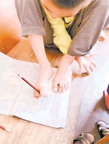10岁脑瘫儿用脚读书写字 行颈动脉外膜剥脱术改善双手功能