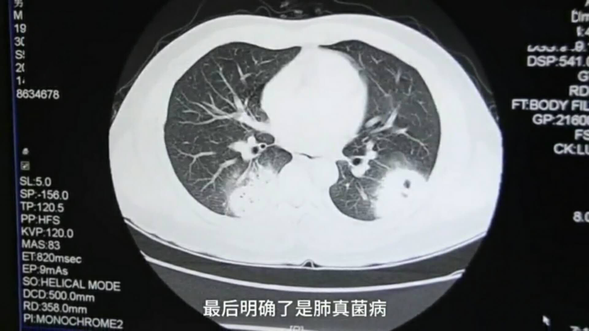 怪癖!男子下班爱闻臭袜子,致使肺部真菌感染,网友:袜子有毒