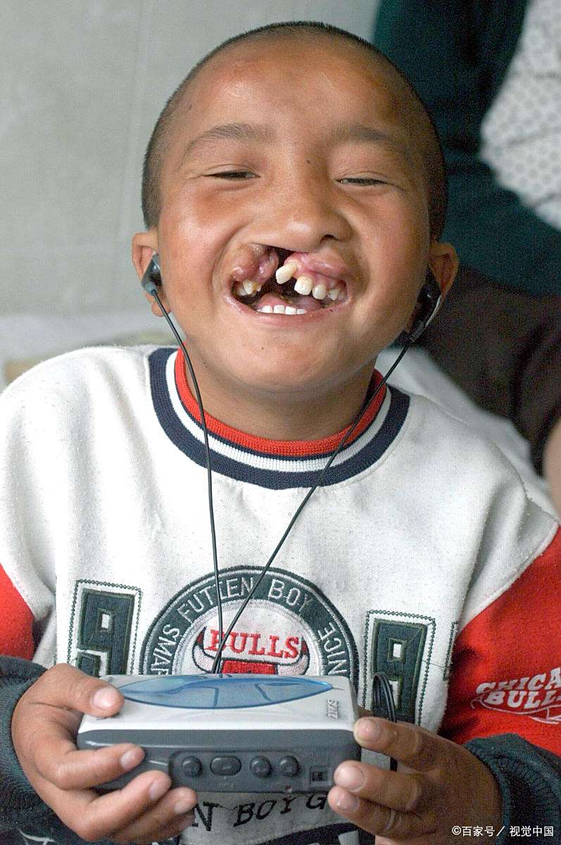 新生为什么会发生腭裂?怎么治疗?新手爸妈应注意什么?