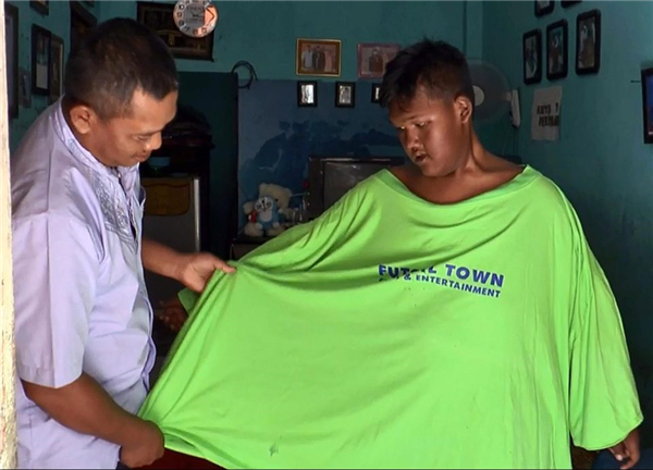 印尼最胖男孩狂甩一半体重 曾重达400斤