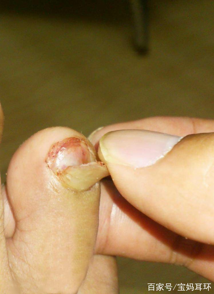 为什么脚趾甲会长到肉里面去为什么在线