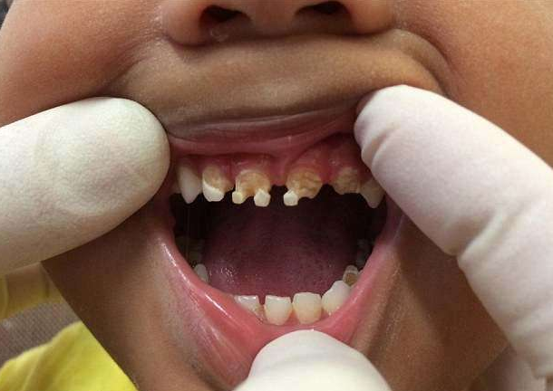 三岁男孩儿由爷爷奶奶照顾,满嘴牙齿腐蚀病,头疼发烧