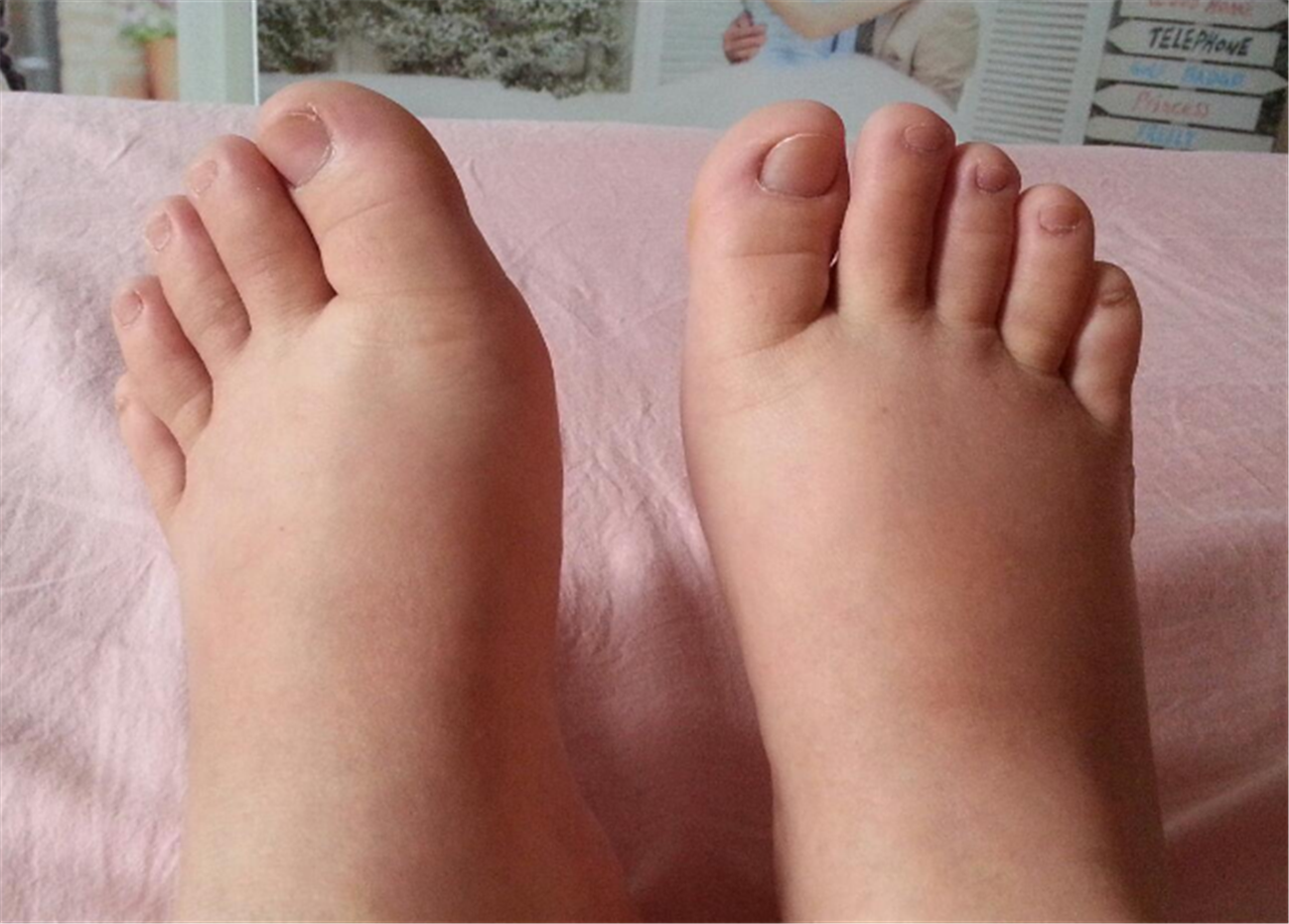 而且还有浮肿,这可能是痛风来临前的信号,因为当人体中的尿酸过高的