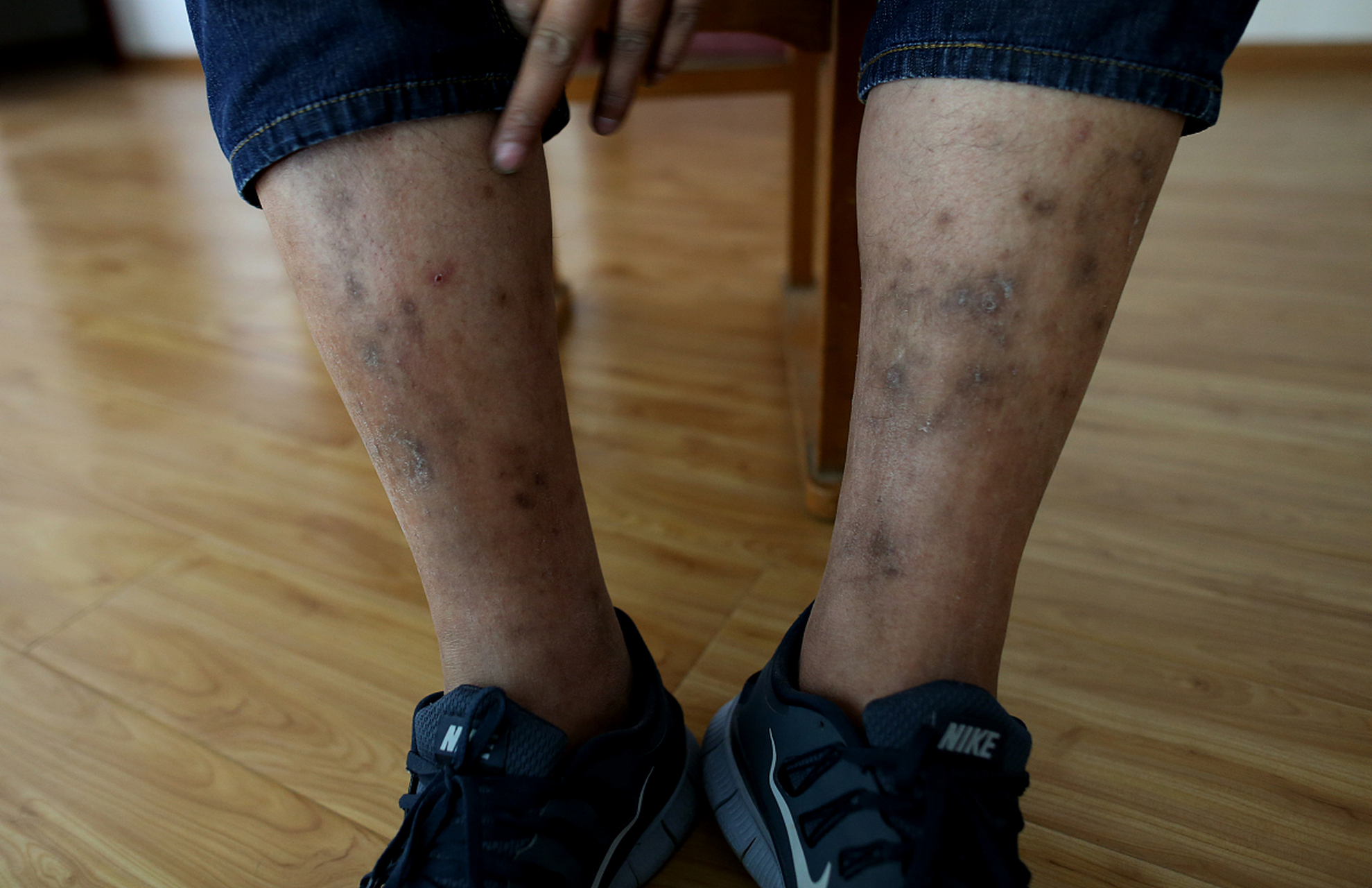 一般情况下,急性荨麻疹通常在短时间内自行消失,不会发展为慢性.