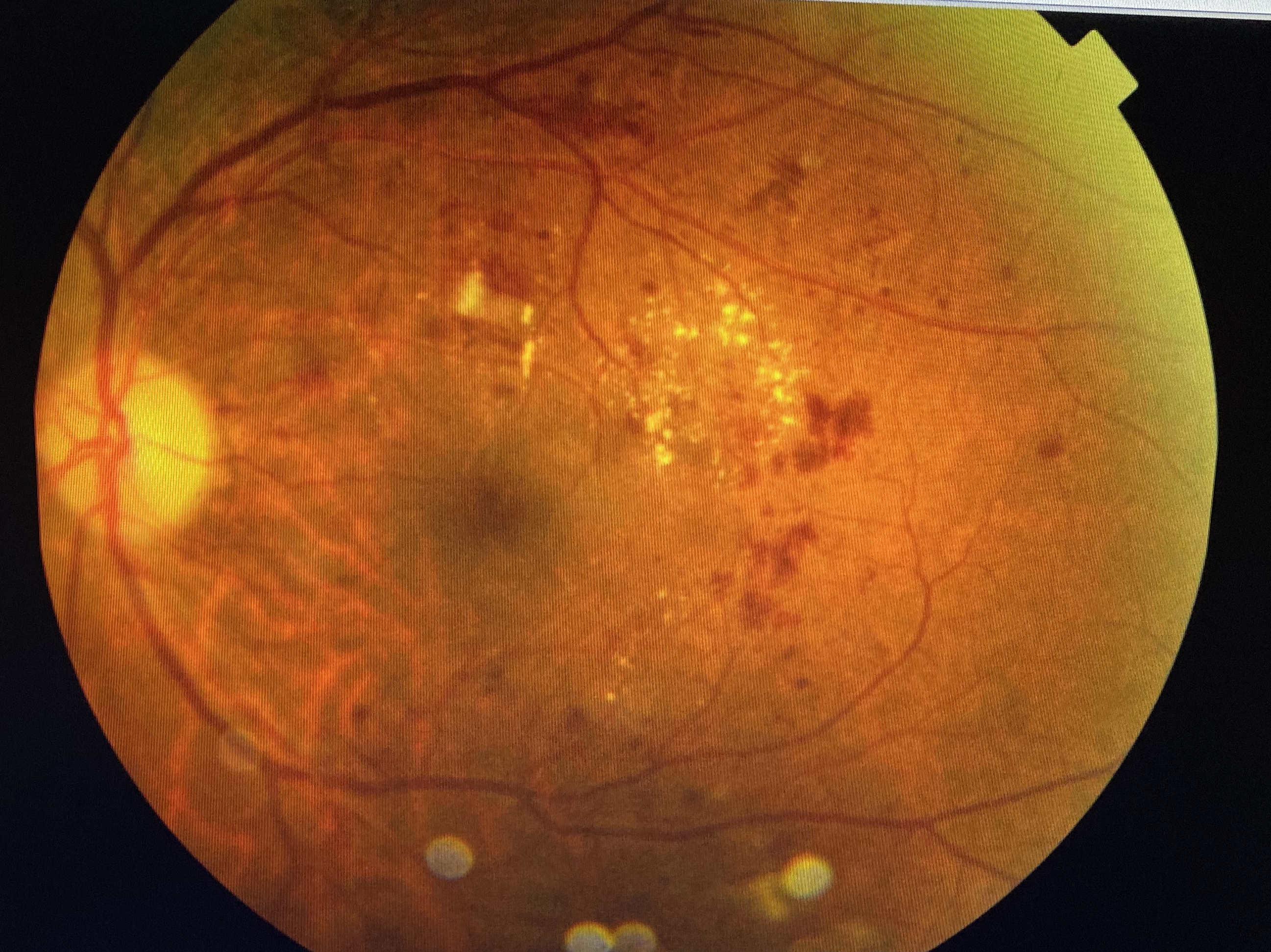 易忽视的糖尿病眼病