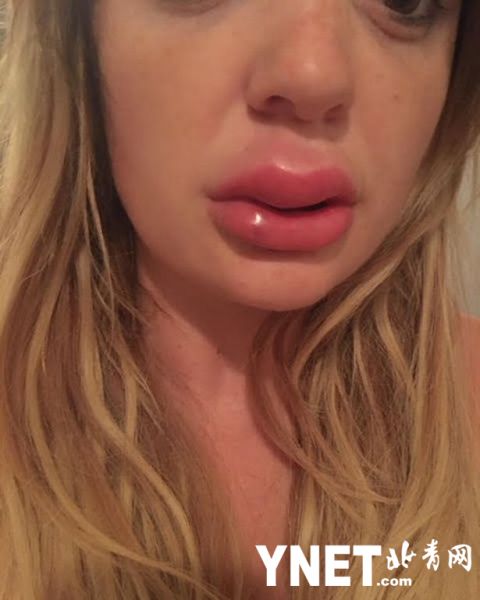 女子丰唇填充物"爆炸" 嘴部肿起自嘲像唐老鸭