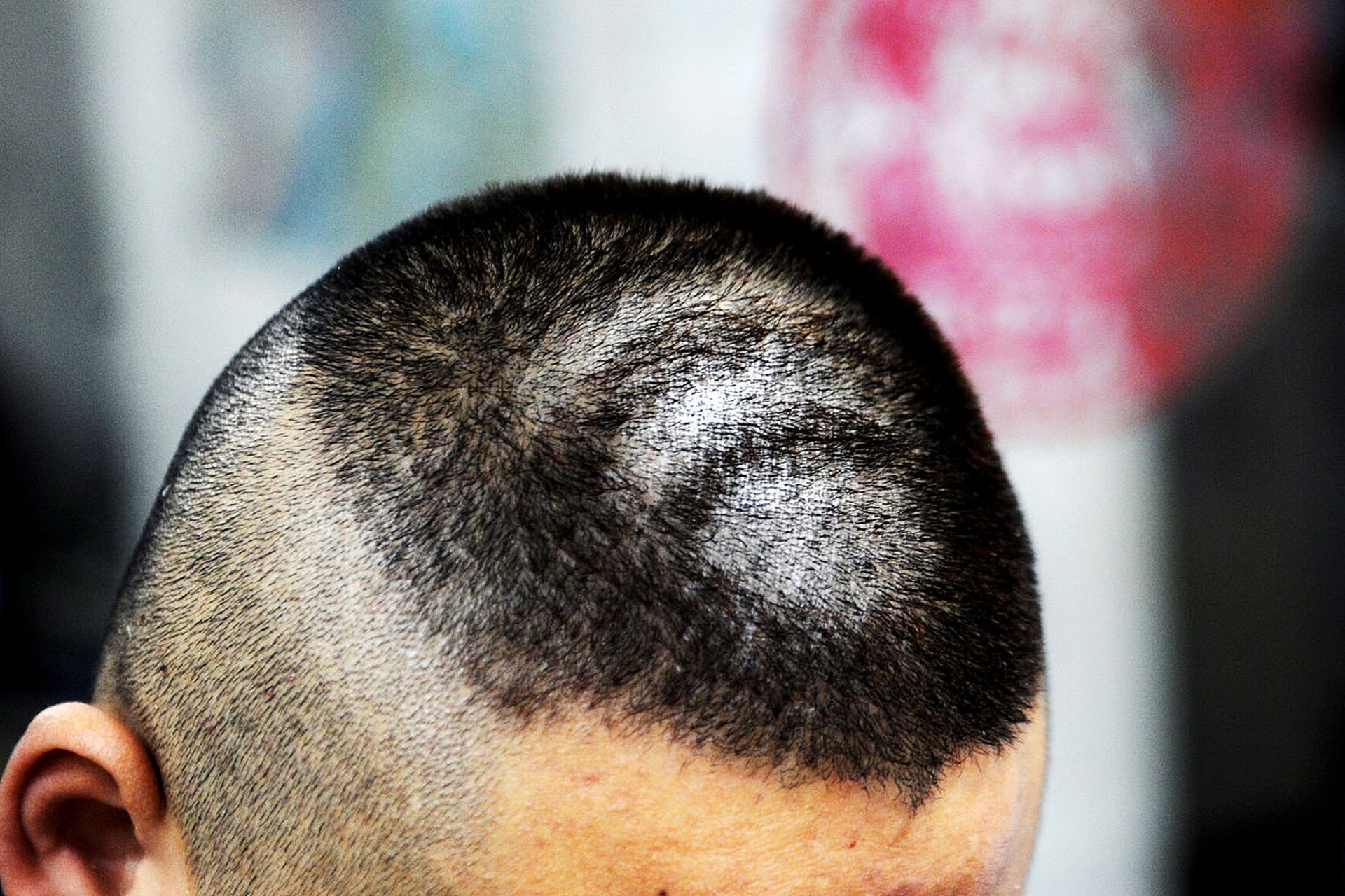 太原市九州皮肤病医院# #头部牛皮癣,又叫头皮银屑病.