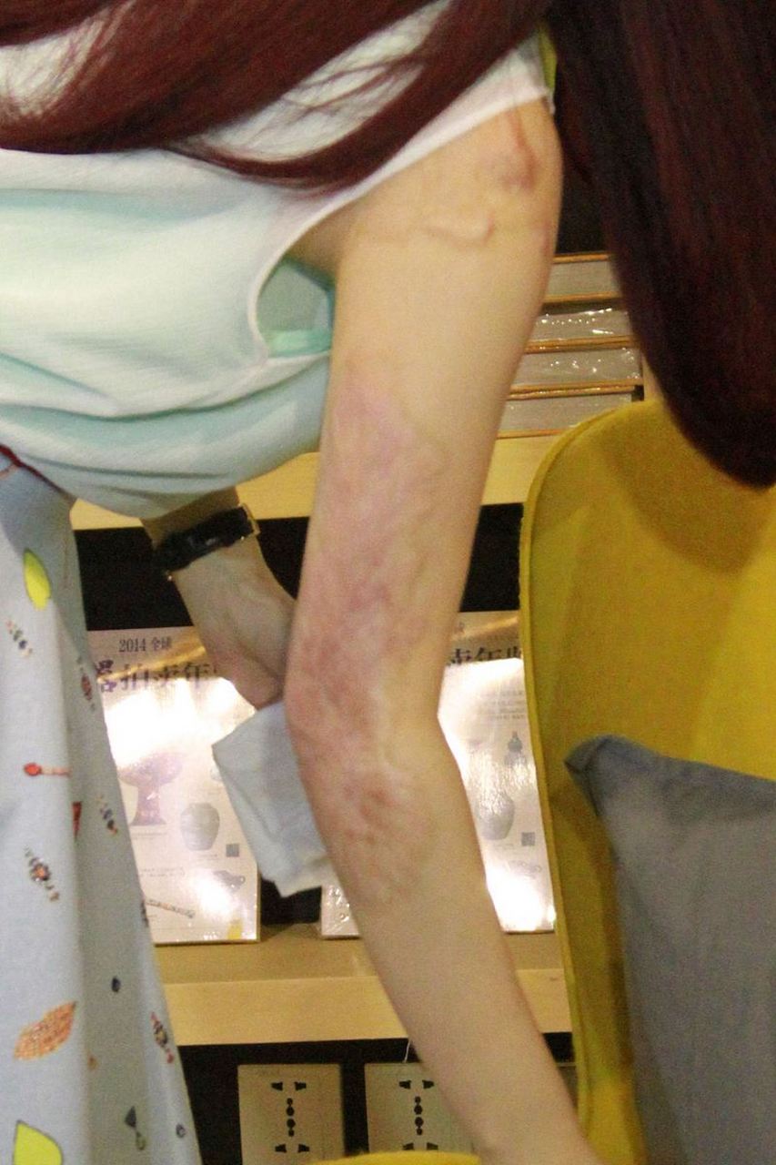 对于烫伤后的疤痕治疗,最佳的时间是在伤口完全愈合后开始