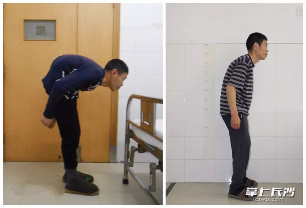 男子90度驼背走路脸朝地,长沙医生手术后,20多年来首次挺直腰杆