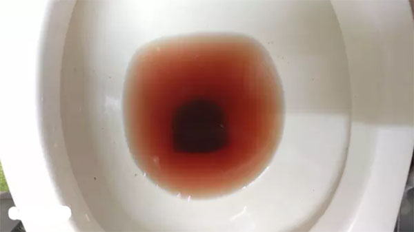 尿液偏红图片